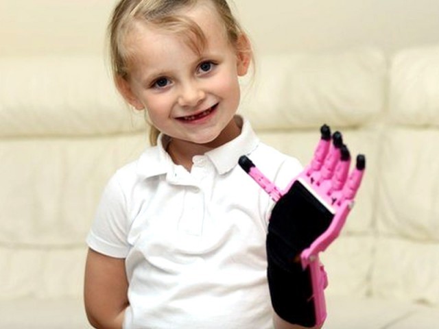 نگلیوں سے محروم 5 سالہ برطانوی لڑکی کیلیے مصنوعی ہاتھ